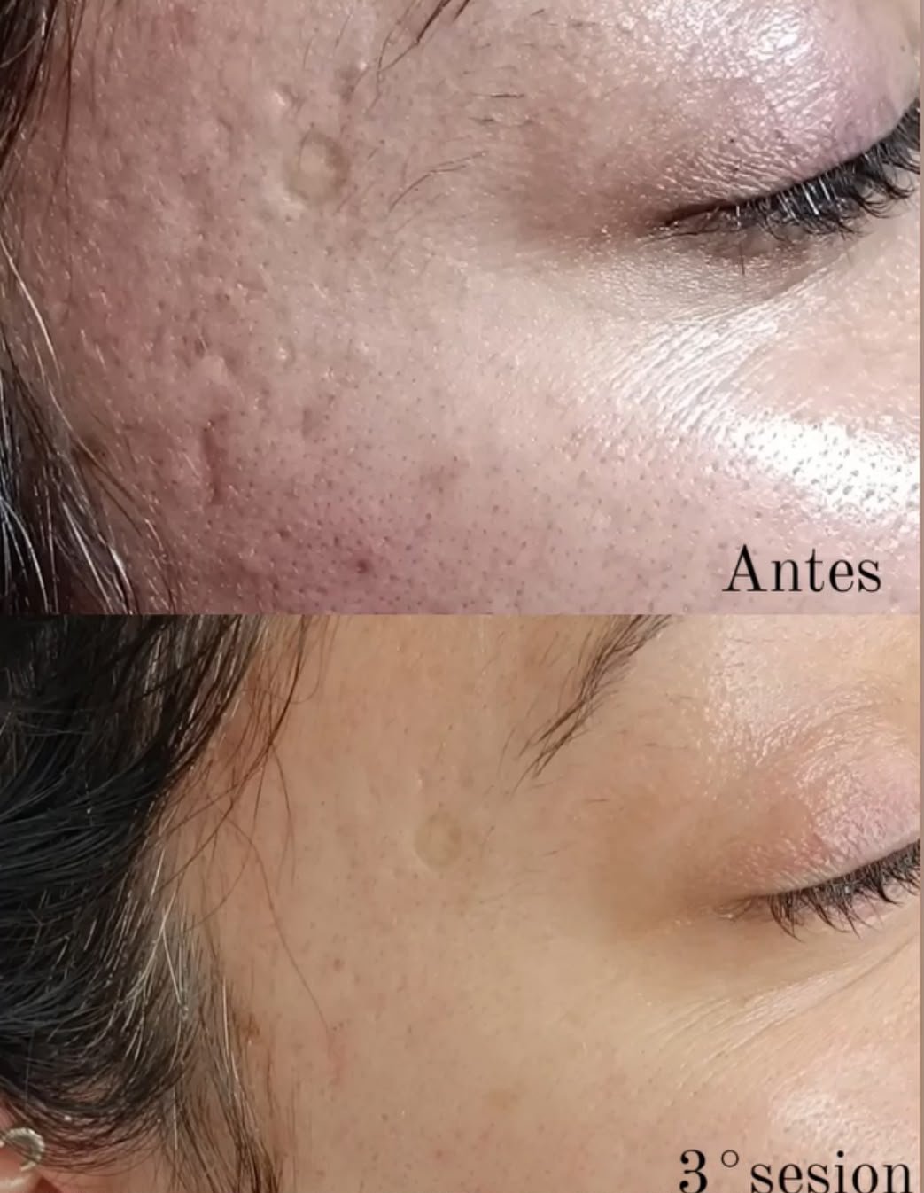 Dermapen + BBGlow