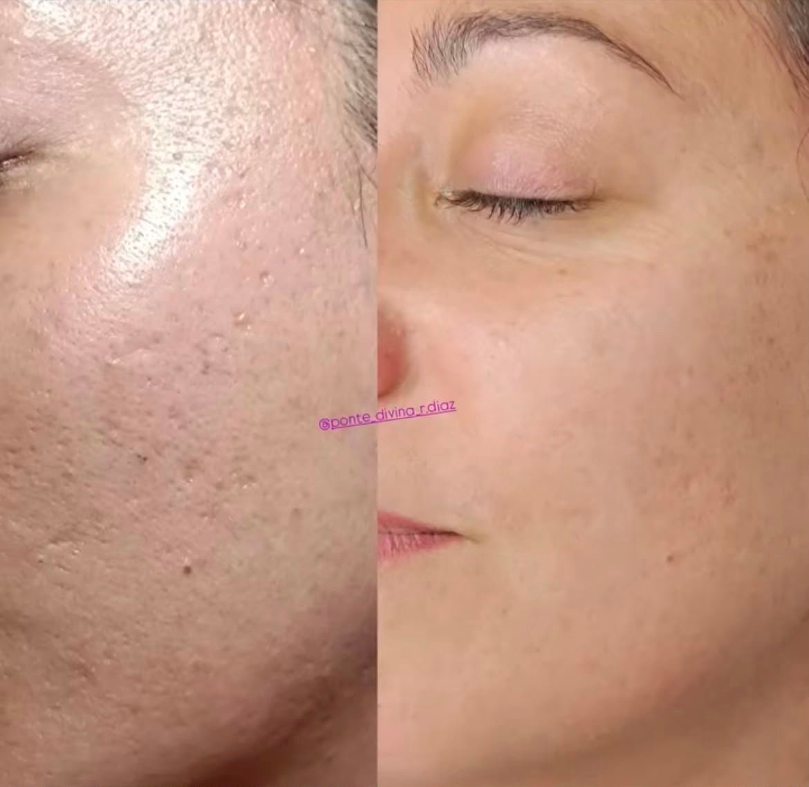 Sesión de Dermapen microneedling