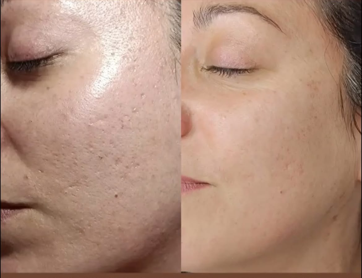 Piel más luminosa tras Dermapen y BBGlow