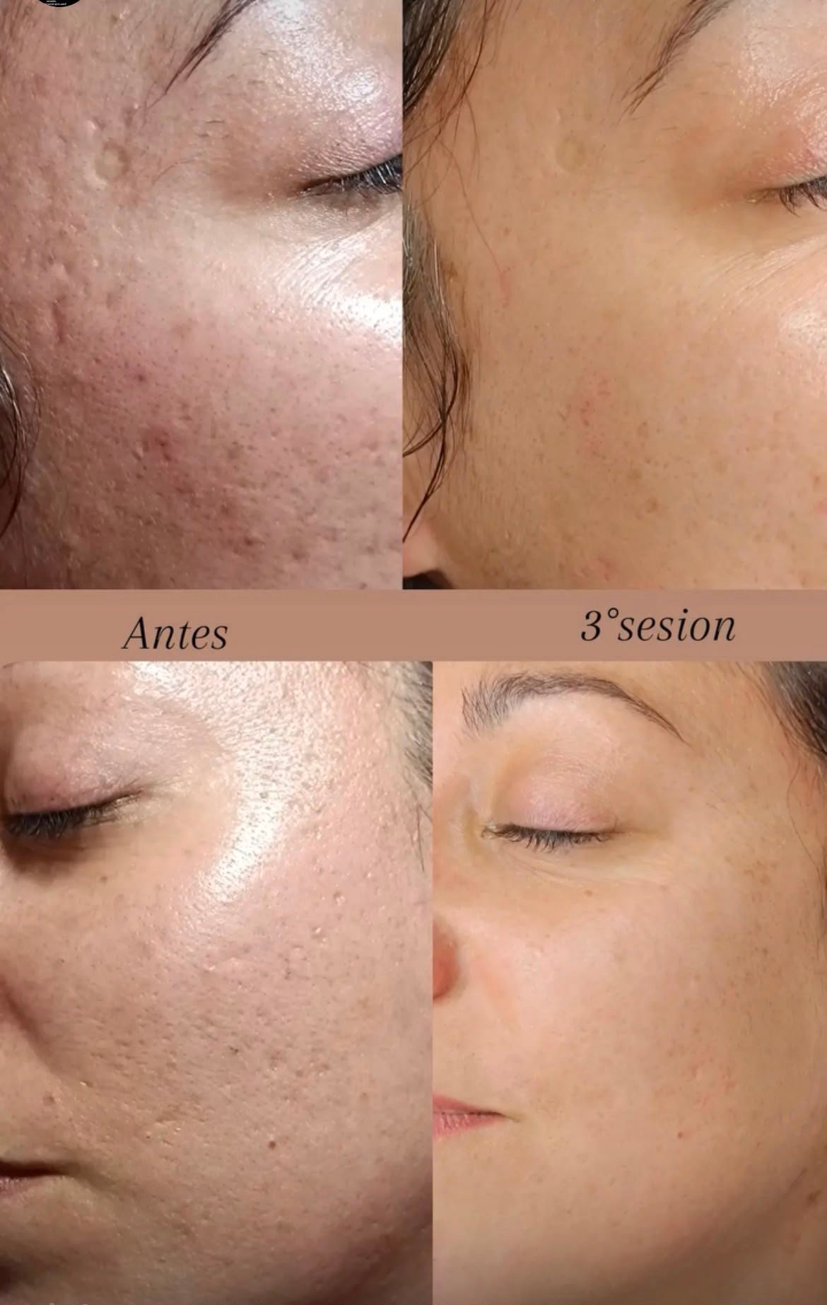 Resultado de Dermapen y BBGlow por sesiones