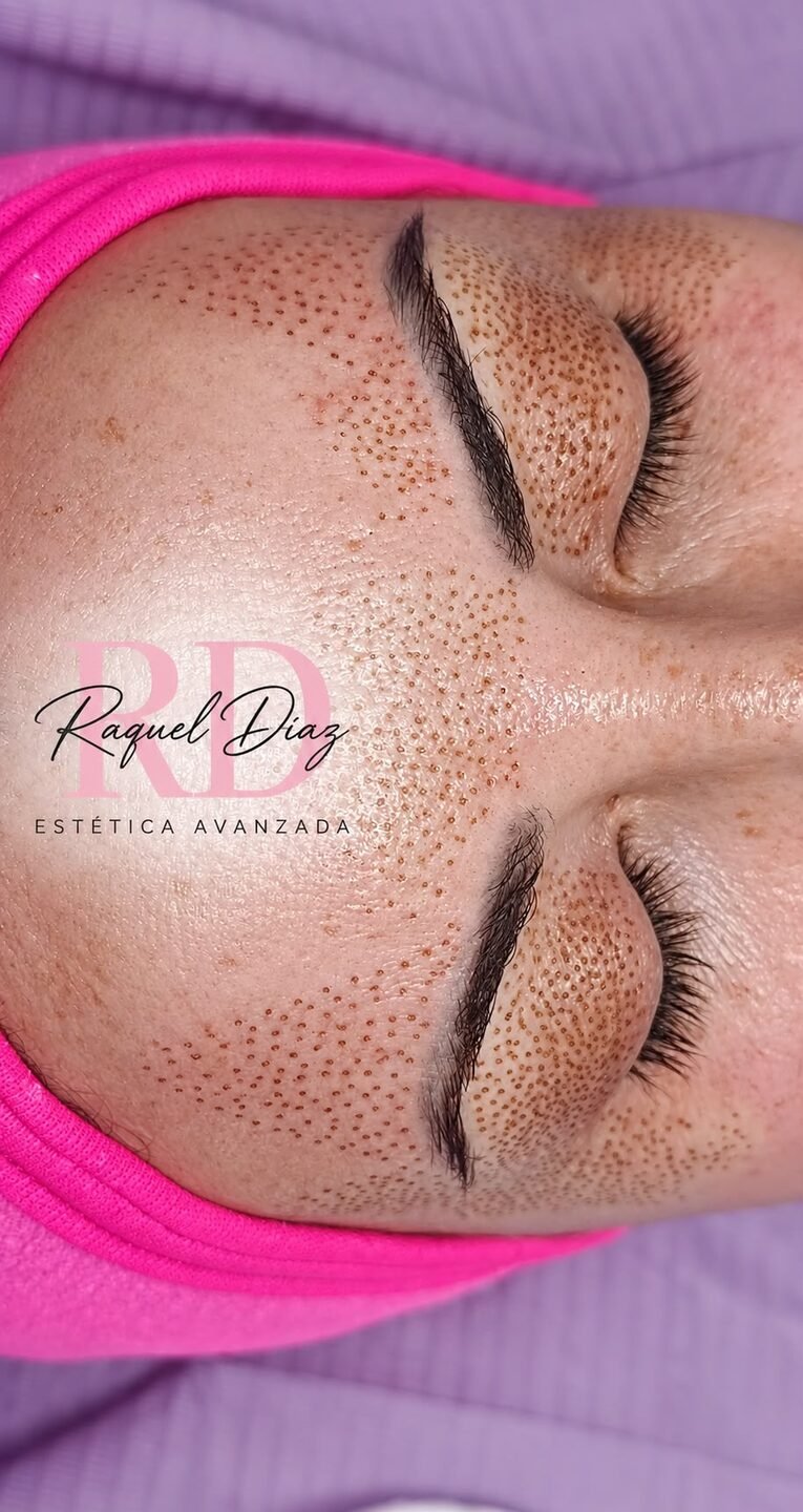 Blefaroplastia sin cirugia