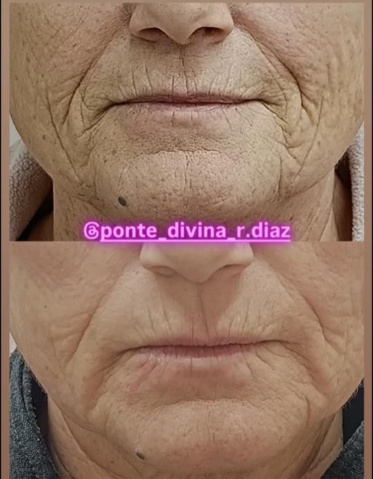 Reducción de arrugas del rostro con Fibroblast