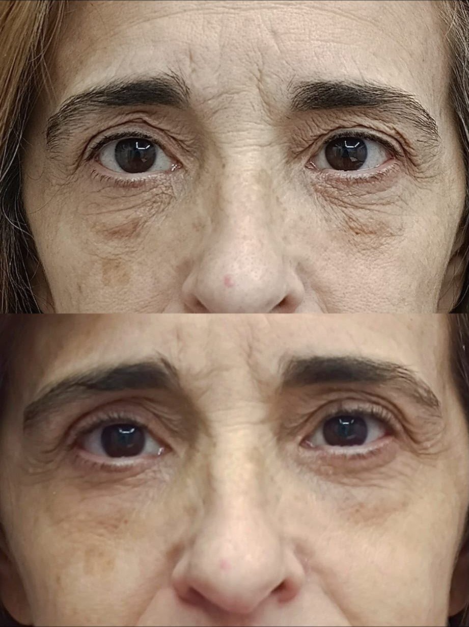 Fibroblast en arrugas periorales, antes y después
