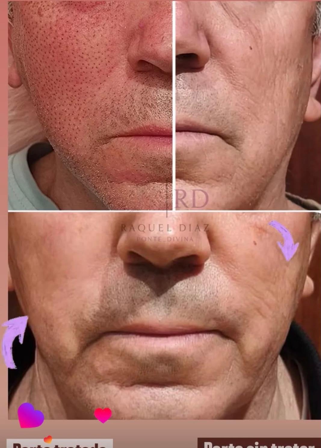 Fibroblast / Plasma Pen: parte tratada frente a parte sin tratar