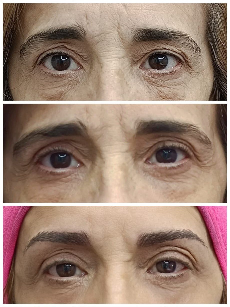 Fibroblast para párpados caídos: rejuvenece la mirada sin cirugía