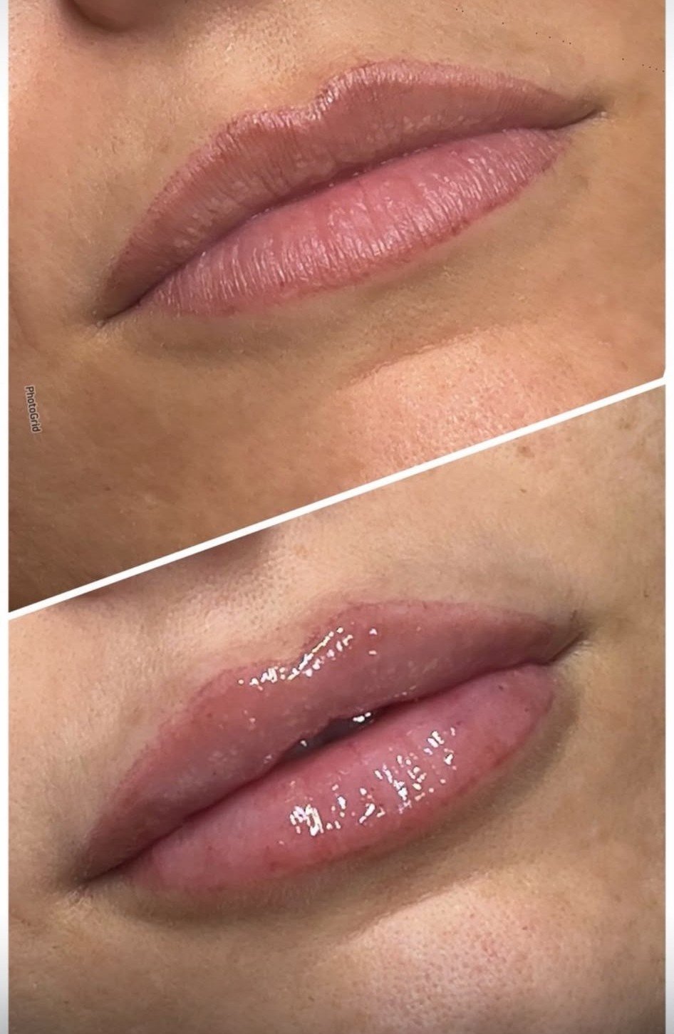 Hyaluron Pen, aumento de labios sin agujas