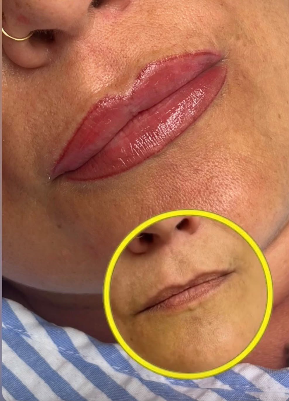Combinado de ácido hialurónico con micropigmentación de labios: resultado