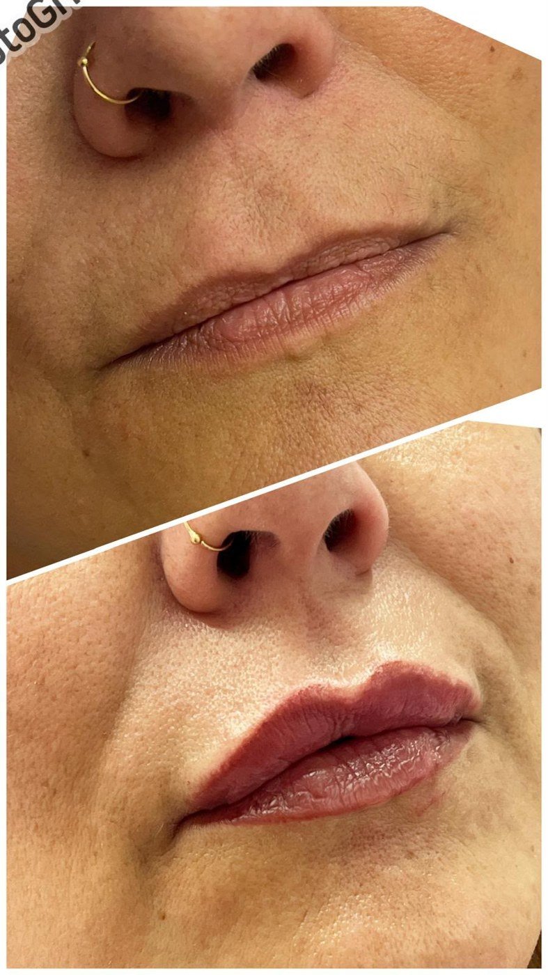 Combinado de labios: micropigmentación con ácido hialurónico, antes y después