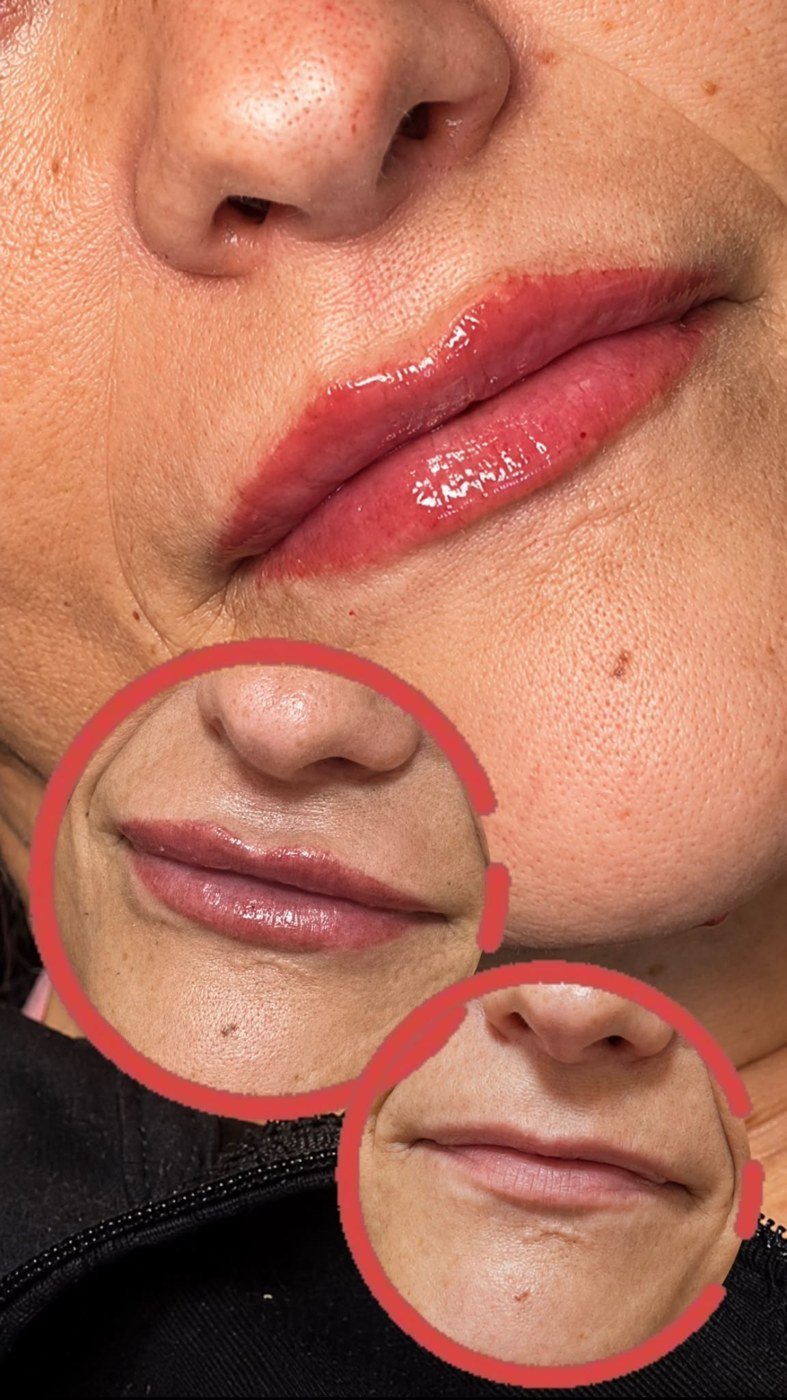 Labios con color y volumen: micropigmentación combinada con ácido hialurónico