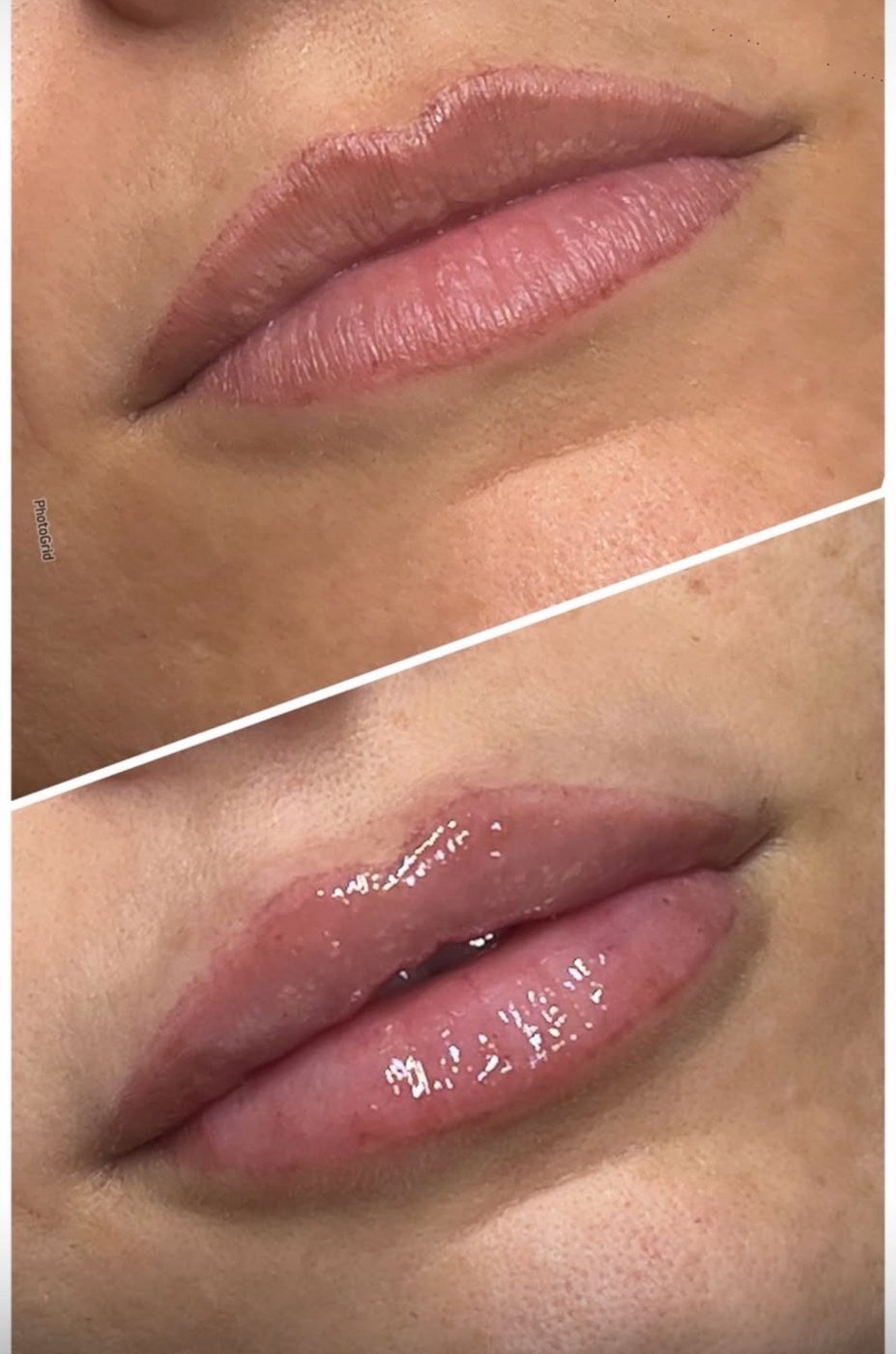 Evolución del labio con ácido hialurónico y micropigmentación