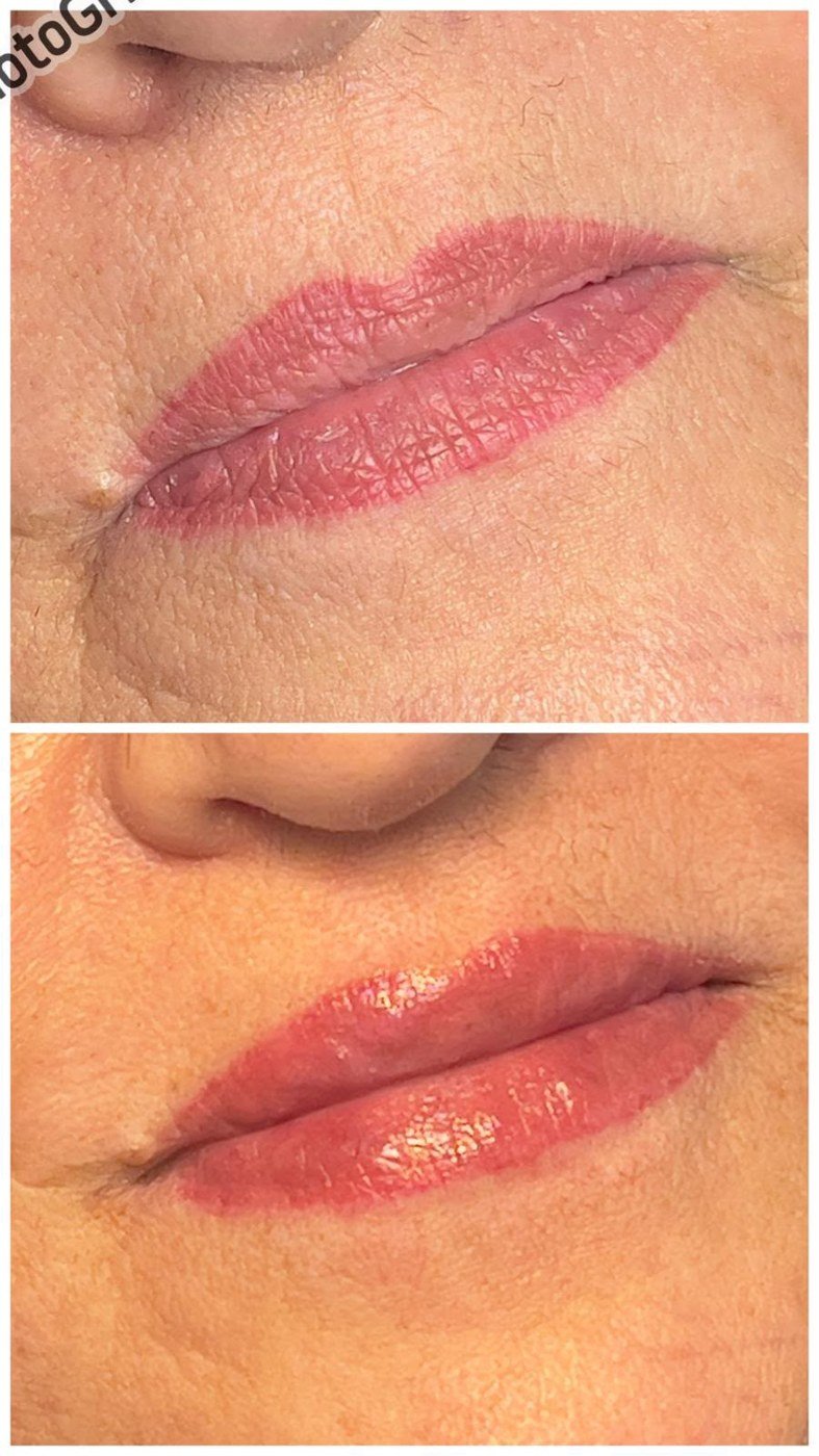Resultado natural de labios con micropigmentación y ácido hialurónico