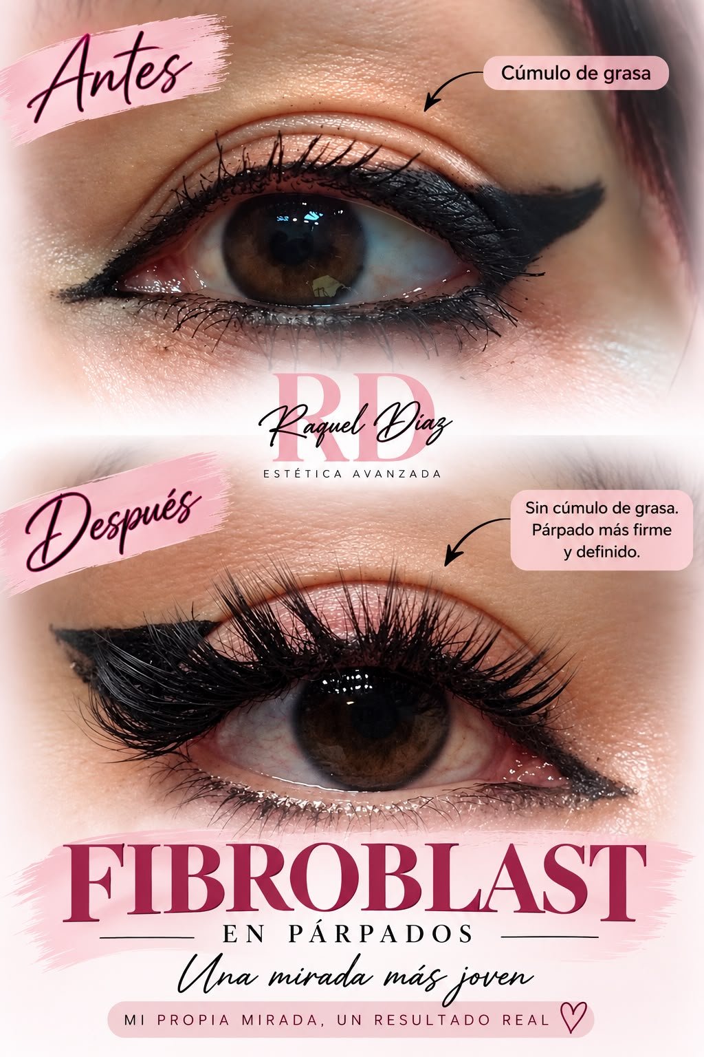 Fibroblast en párpados, caso real: mi propia mirada, sin cúmulo de grasa y párpado más firme