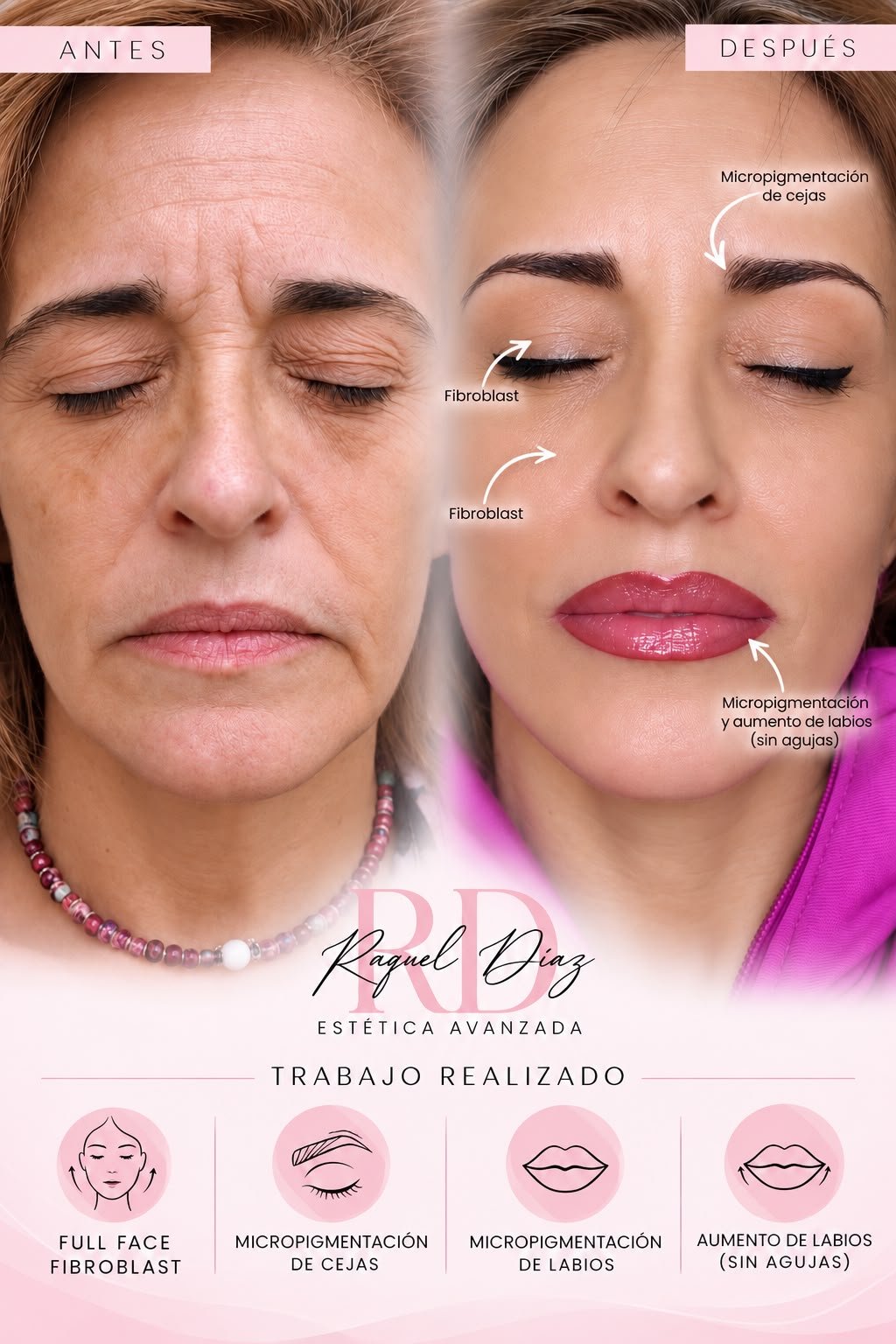 Antes y después: Full Face Fibroblast, micropigmentación de cejas y labios y aumento de labios sin agujas