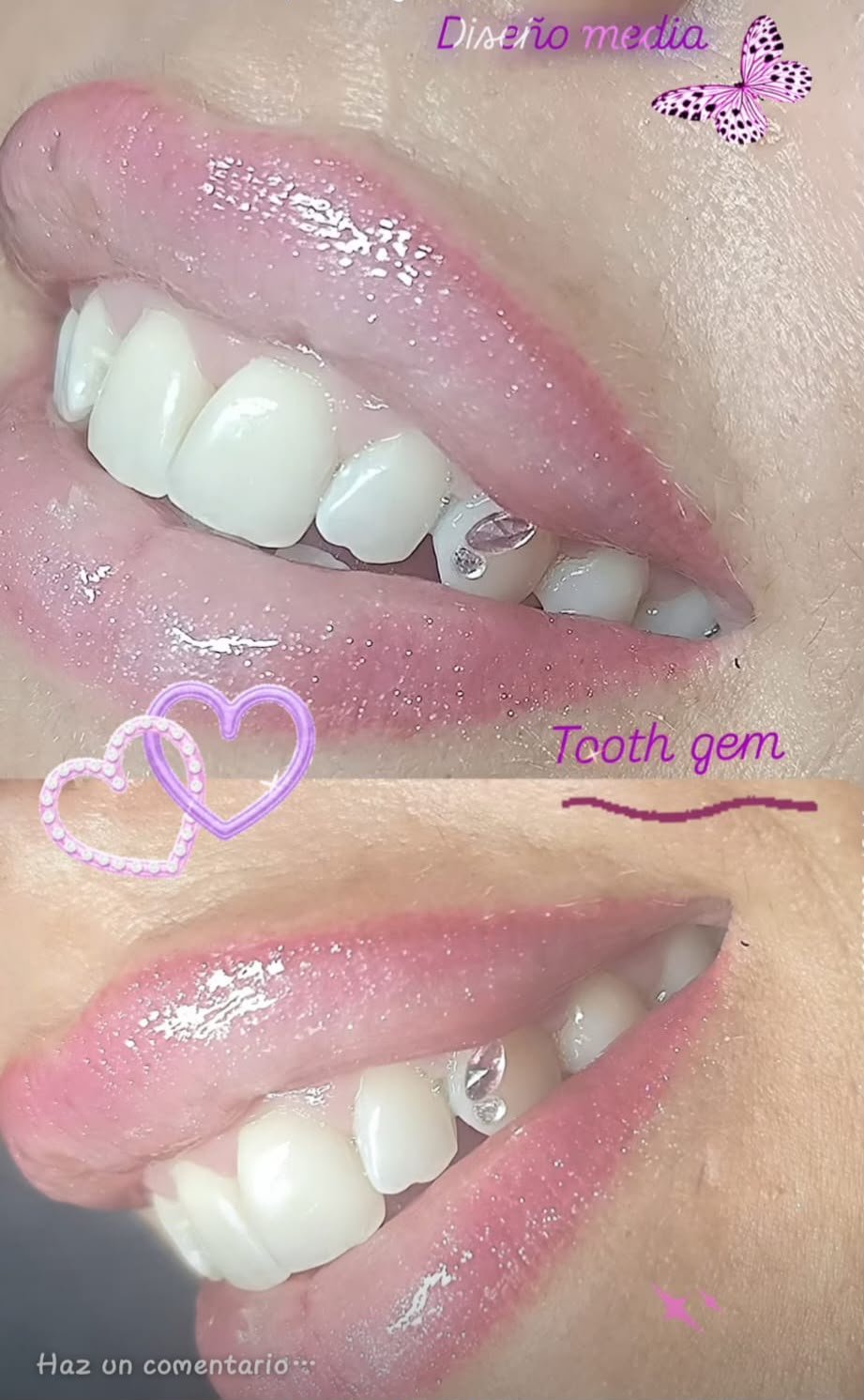 Tooth gem