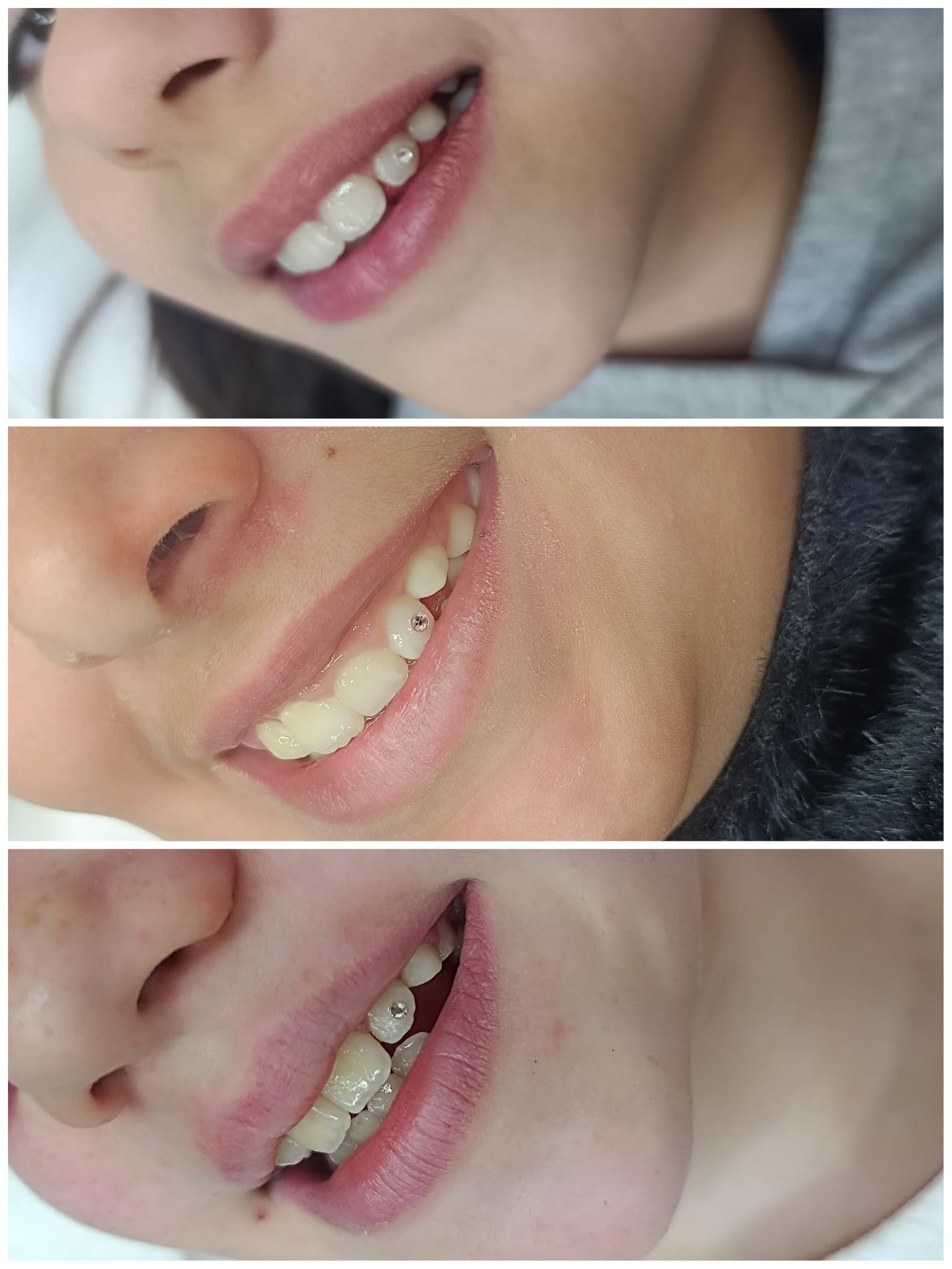 Tooth gem joya dental colocada